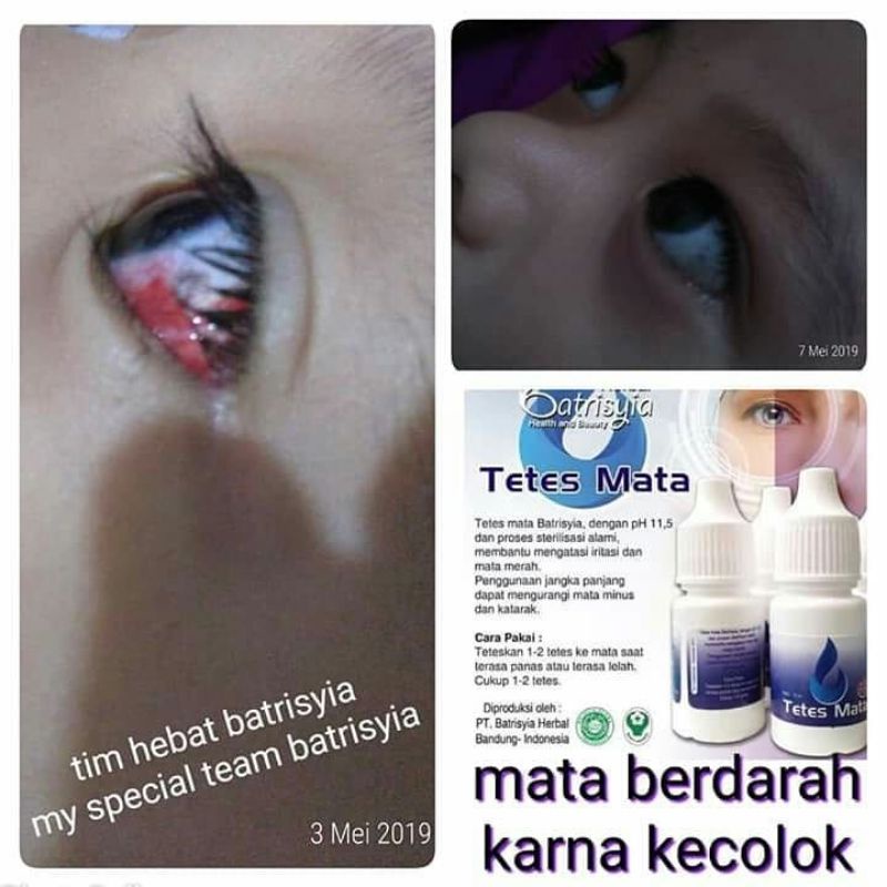 (BISA COD/ BAYAR DI TEMPAT) Obat tetes mata anak / obat tetes mata bayi/tetes mata anak bengkak merah berdarah bintitan belekan aman untuk bayi/ tetes mata iritasi anak