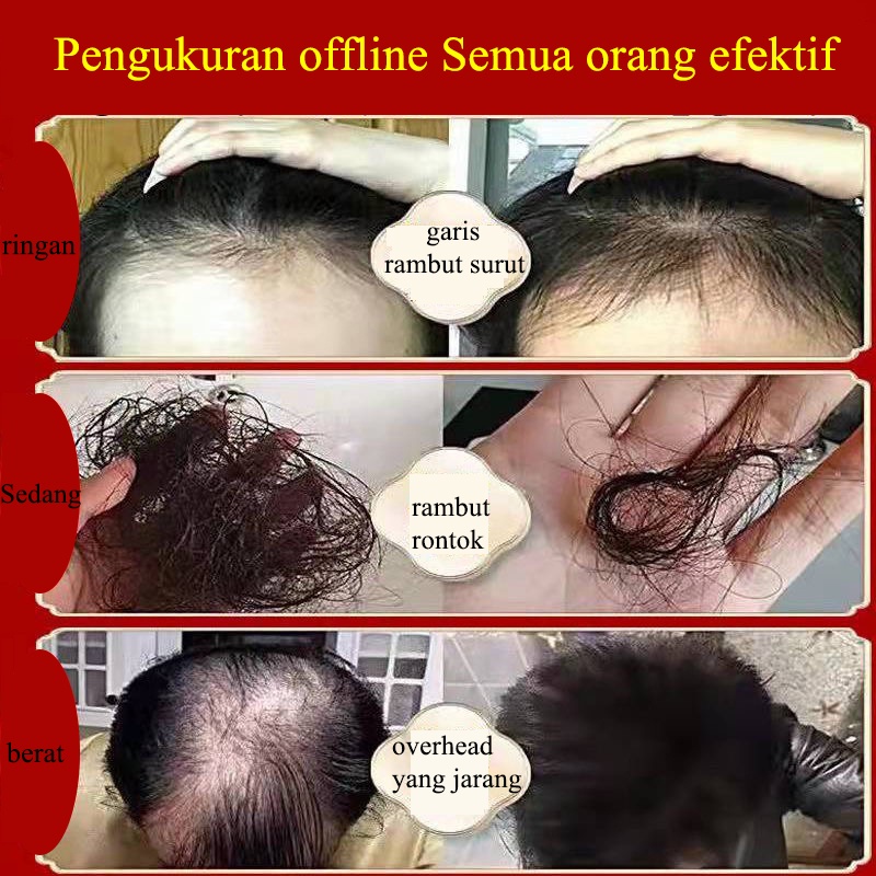 penumbuh rambut serum 30ml hair care Cepat dan efektif anti kebotakan/pertumbuhan rambut/perawatan kulit kepala/penebalan rambut