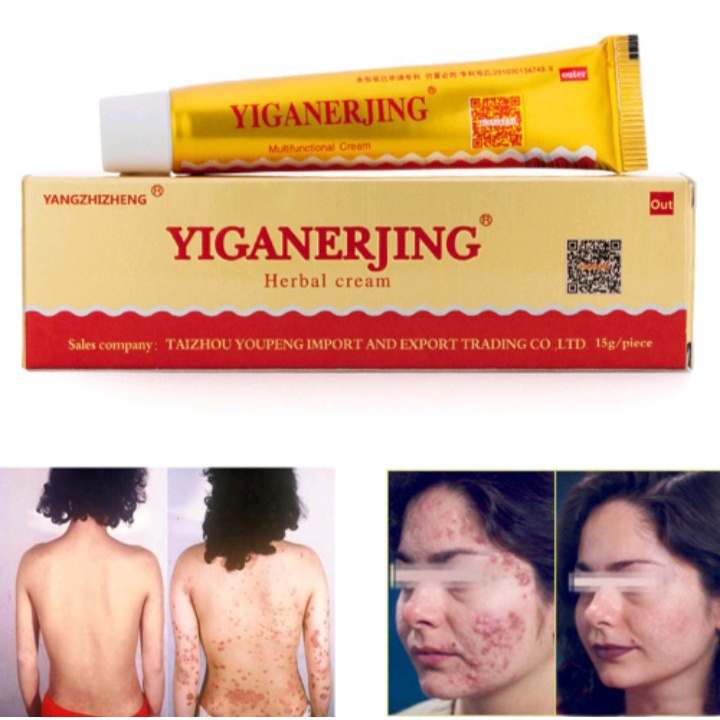 [BISA COD] Salep Yiganerjing | Cream Yiganerjing 15Gram | Salep Eksim Jamur Psoriasis Dermatitis | Salep Herbal