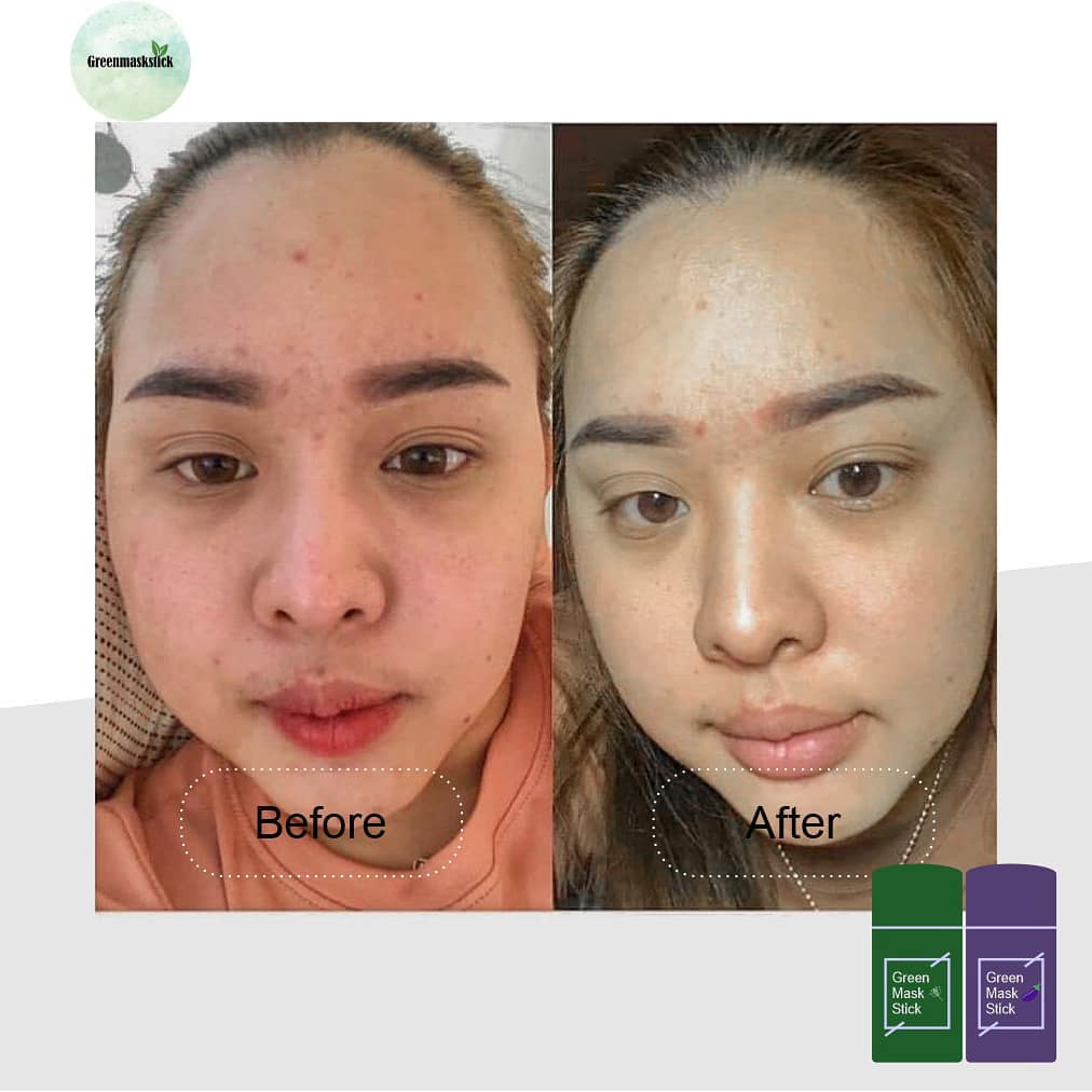 Original Greentea Mask Stick Meidian | Green Stick Mask / Masker Komedo / Jerawat Dan Bekas Jerawat Bruntusan isi 40Gr ANAK PRIA BPOM ORGANIK MURAH MEIDIAN