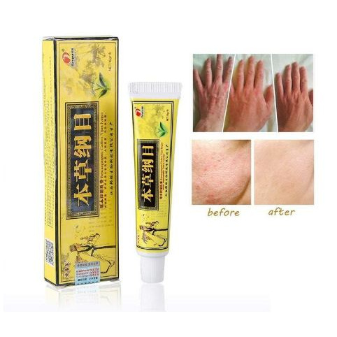 Obat Eksim Salep Gatal Salep Eksim Krim Kulit Psoriasis Dermatitis Eksim - Salep Kuning Obat Salep Gatal Kulit