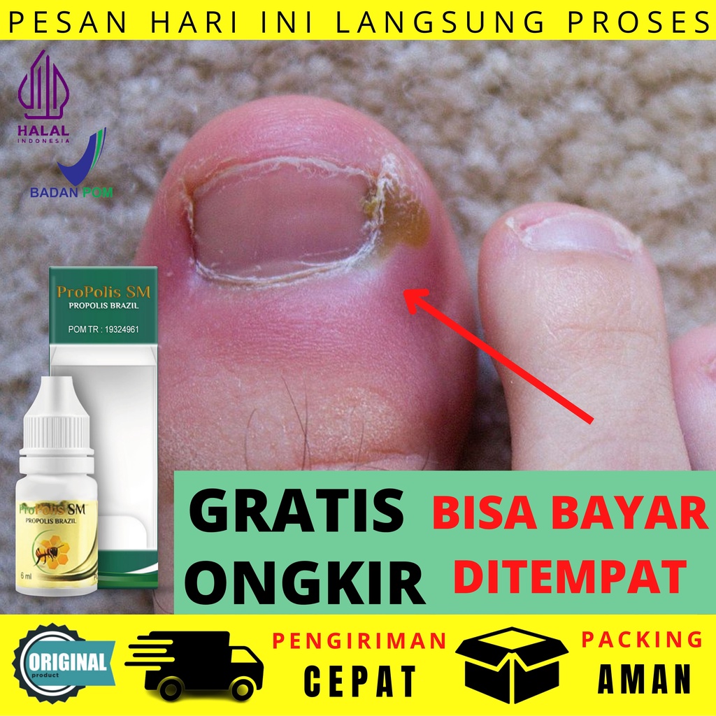 Obat Kaki Cantengan Kuku Bernanah Infeksi Jamur Berjamur Diabetes Paronikia Borok Bekas Luka Gangren
