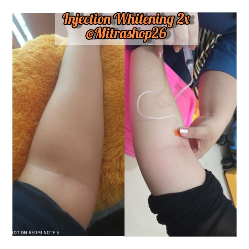 Injection Whitening