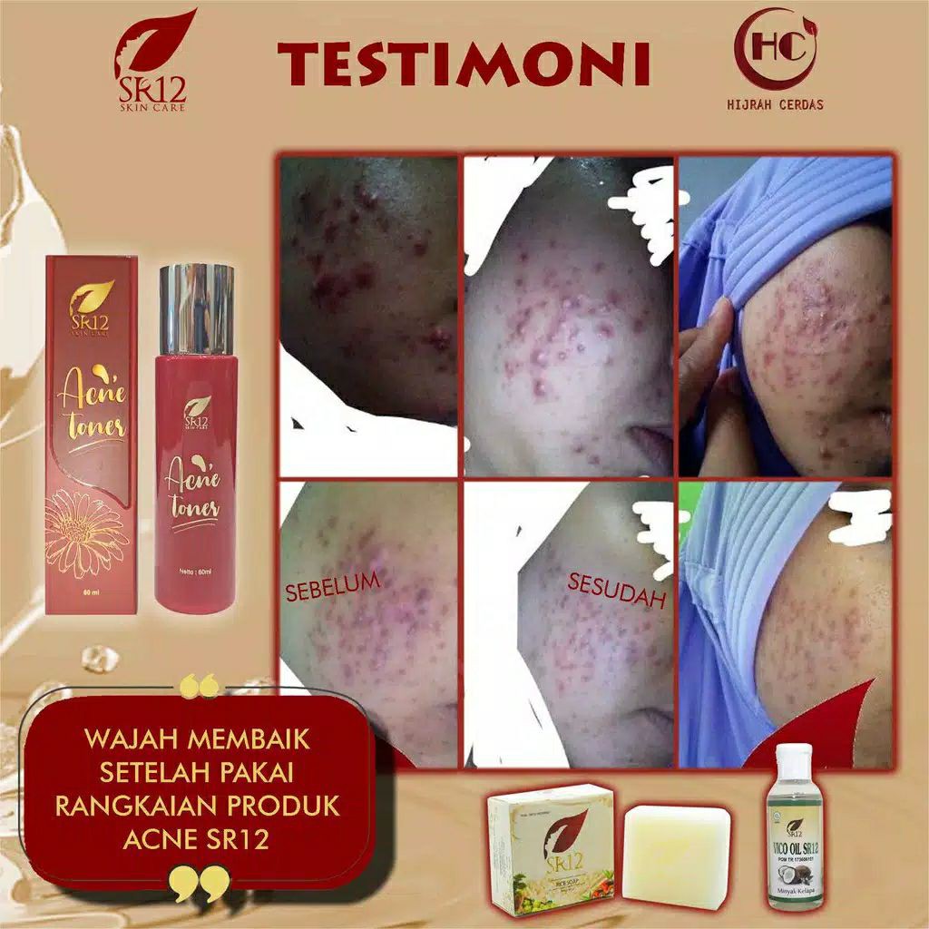 ACNE TONER SR12 / TONER JERAWAT BPOM / OBAT JERAWAT BERUNTUS / PENYEGAR KULIT WAJAH 60 ML