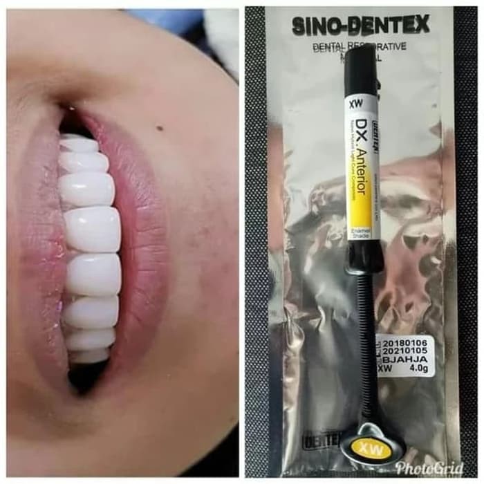 komposit dentex super white composite veneer gigi super white xw