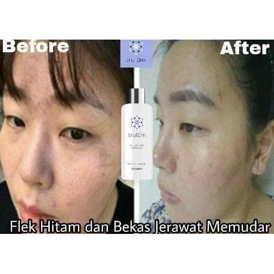 Paling Populer Cream Untuk Penghilang Flek Hitam | Obat Flek Hitam