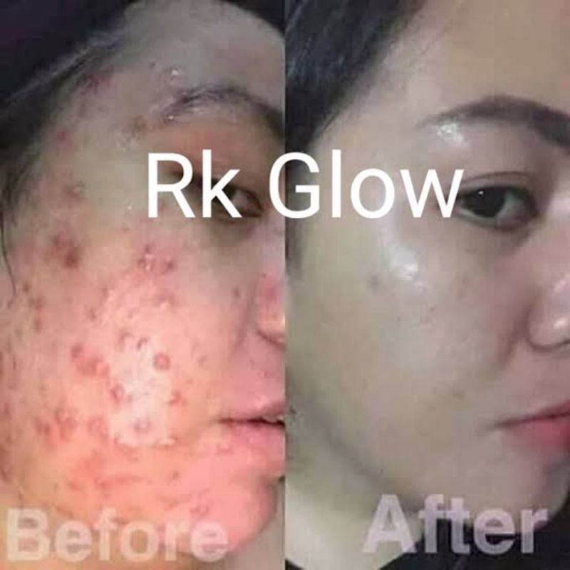 COD - RK GLOW ACNE - PAKET SKINCARE JERAWAT - MENGHILANGKAN ACNE DAN BEKASNYA - MEMBUAT MULUS