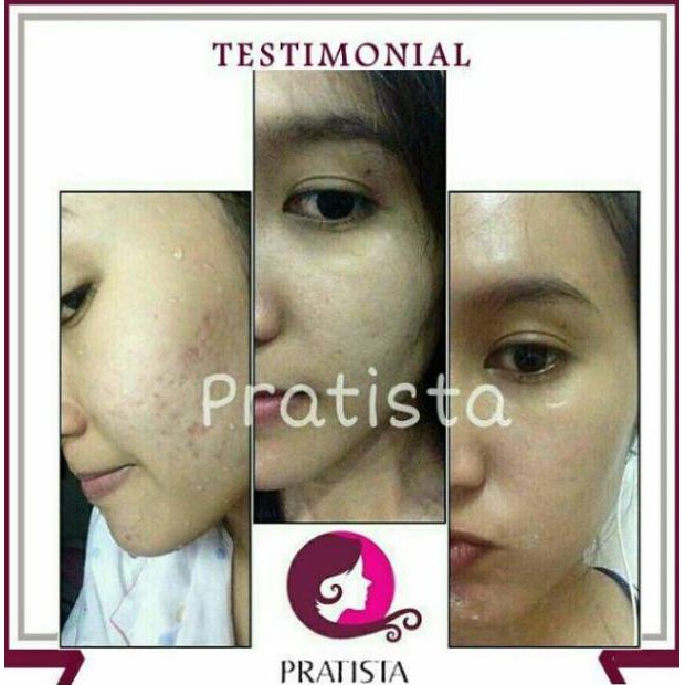 Cream Penghilang Bopeng Bekas Jerawat dan Cacar