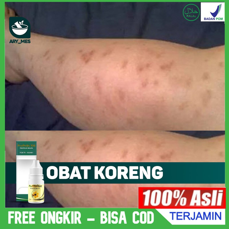 Obat Koreng - Koreng Basah Kering - Luka Koreng, Di Wajah, Di Kepala, Di Tangan, Di Kaki Propolis SM