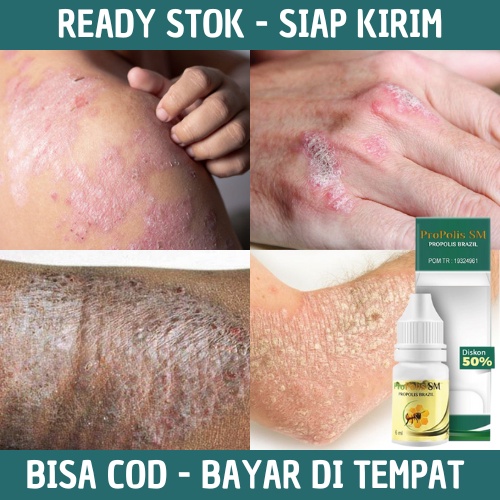 Obat Eksim Kering Menahun, Penghilang Gatal Gatel Eksim Kering Basah, Obat Eksim Bernanah, Obat Psor