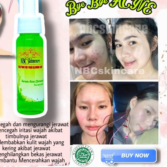 NBC Skincare - Serum Acne Jerawat (krim artis) ❆