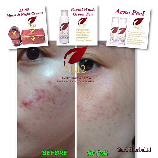 SR12 HERBAL SKINCARE ACNE MOIST CREAM / KRIM TUMPAS JERAWAT BPOM MENCERAHKAN KERUTAN WAJAH