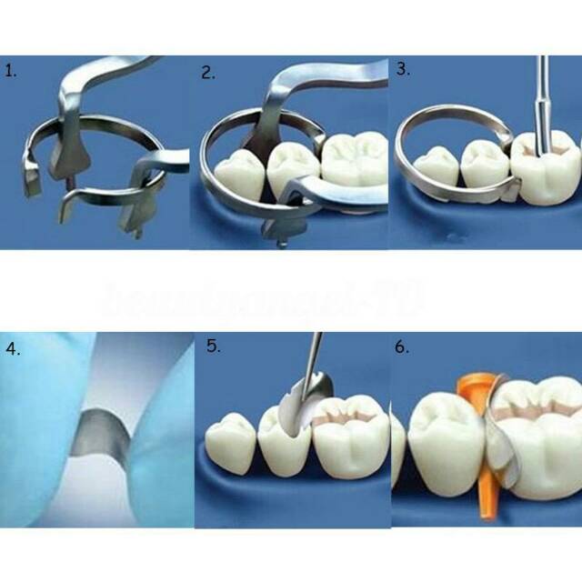 Alice dental sectional contoured matrix metal ginjal band wedges set isi 100 matriks universal gigi