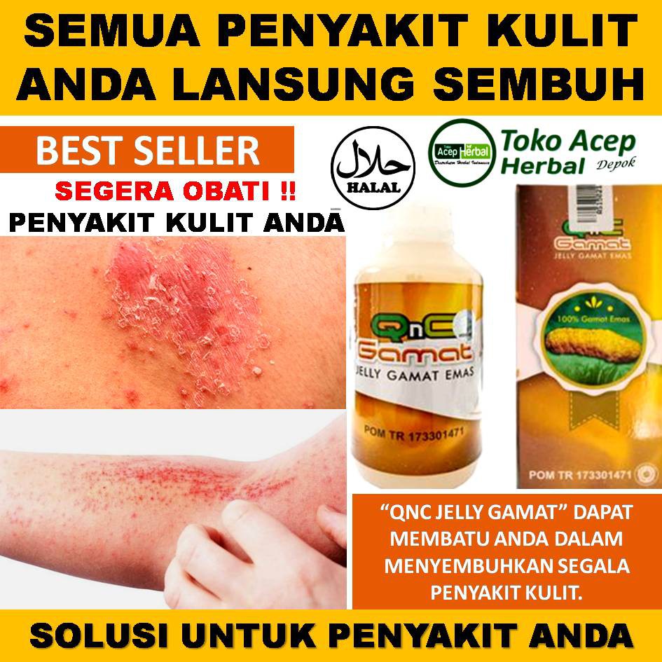 Obat Penyakit Kulit Eskim Psoriasis Gudik Dan Lain Sebagainya Sembuh Total Qnc Jelly Gamat Indonesia