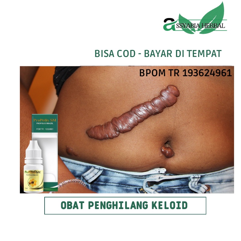 Obat Penghilang Keloid, Keloid Bekas Operasi, Keloid Bekas Sc, Keloid Bekas Luka, Keloid Bekas Cacar