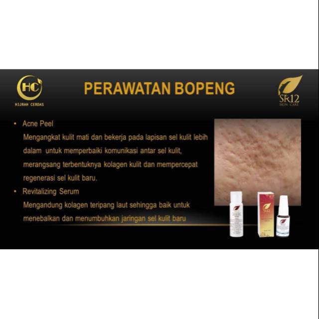 PAKET BOPENG/ BEKAS JERAWAT