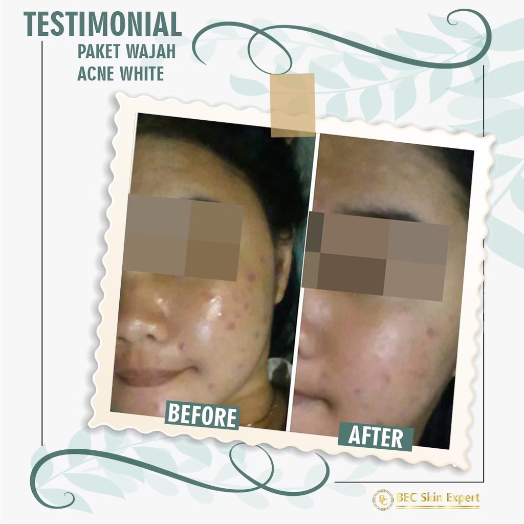 BEC Skin Expert -  Paket Wajah Treatment Series-6
