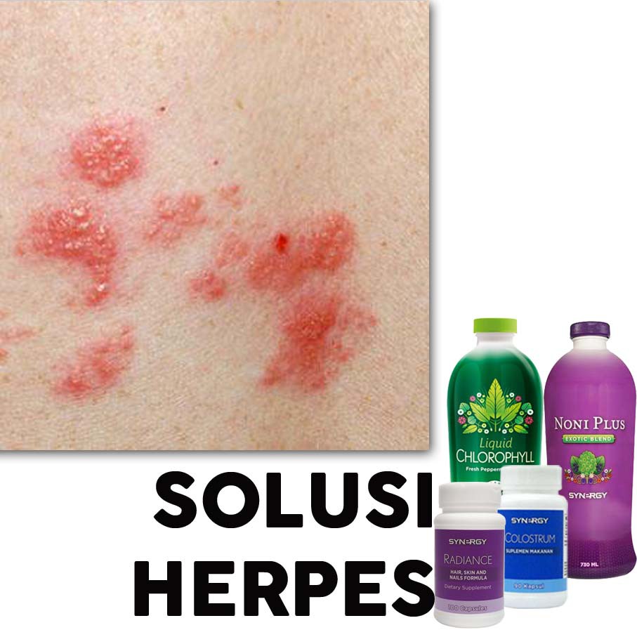 Obat Menyembuhkan Cacar Api / Cacar Ular / Herpes Import USA