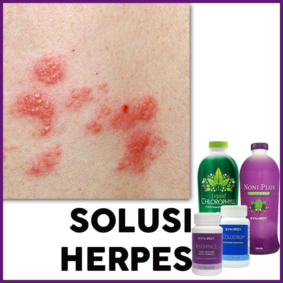 PROMO HERBAL Dompo / Herves / Cacar Api Tanpa Acyclovir