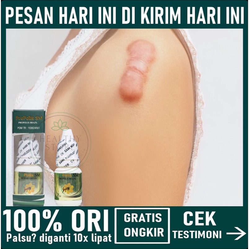 Obat Keloid Bekas Luka - Obat Keloid Bekas Luka Operasi - Obat Keloid Daging Tumbuh - Obat Keloid
