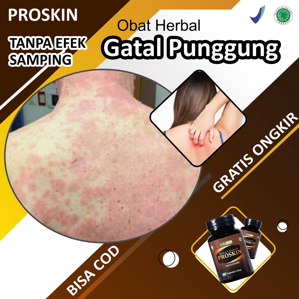 Obat Gatal Punggung Bercak Bentol Paling Alami Penghilang Gatal Jamur Kulit Panu Bintik Alergi Eksim
