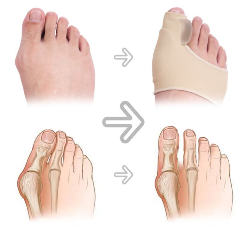 1 Pasang Korektor Kaki Orthotics Kaki Perawatan Kaki Tulang Jempol Adjuster Koreksi Kaus Kaki Pedikur Lembut