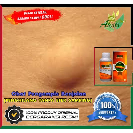 Obat lipoma Di dahi daging tumbuh penghancur lipoma benjolan kecil - QnC jelly Gamat