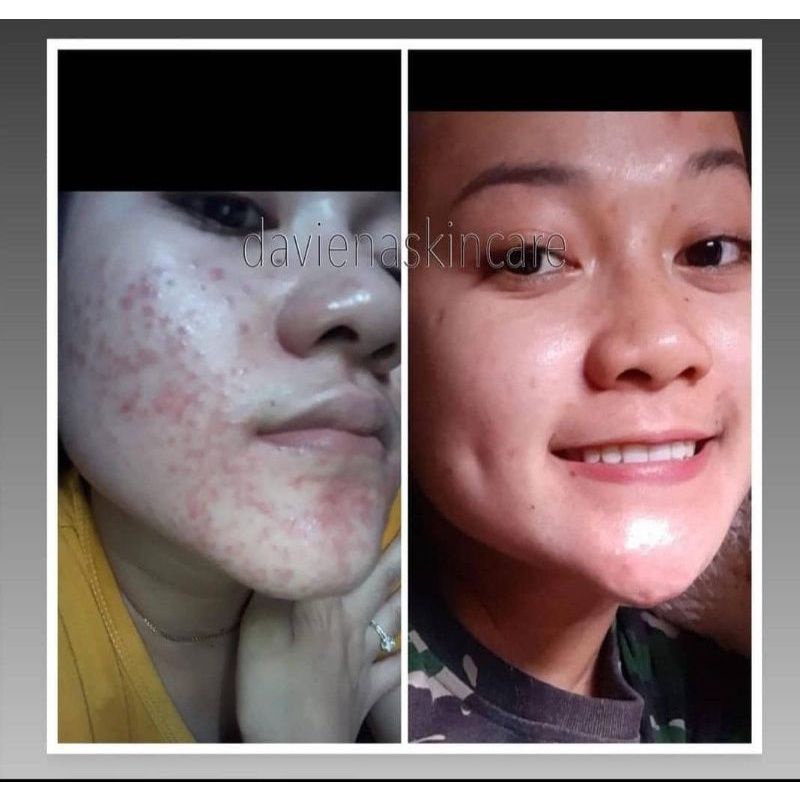 Paket Hemat Acne 1 Daviena Skincare Davienaskincareofficial Davina Devina Lampung Surabaya Jakarta Jerawat Pencerah Pemutih Wajah Bpom Daviena Skincare