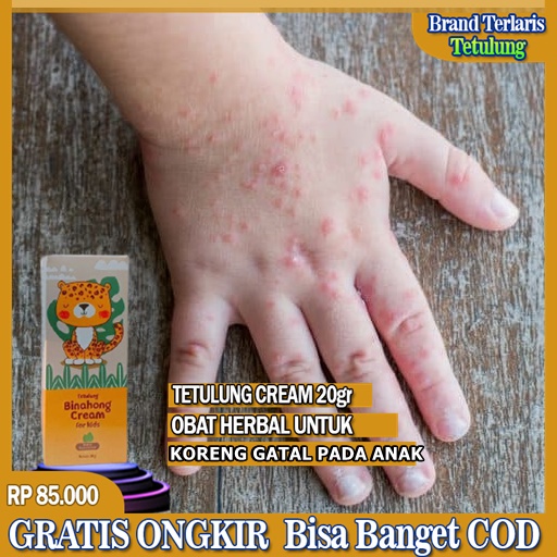 Obat Prurigo, Obat Koreng Gatal, Darah Manis, Bekas Luka Koreng Anak, Penghilang Koreng Hitam Cream 