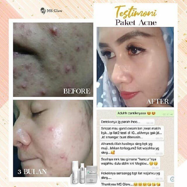 Ms Glow Original Paket Perawatan Wajah Paket Whitening Luminous Mencerahkan Wajah / Paket Ultimate Acne Wajah Berjerawat Skincare Msglow BPOM