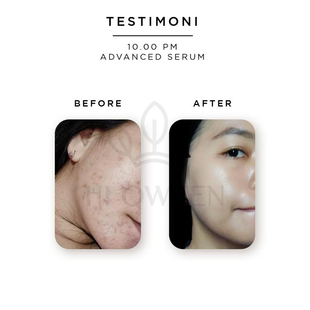 Hiqween 10:00pm Advanced Serum Juara atasi kulit bruntusan, Kering, Jerawat dan Kusam