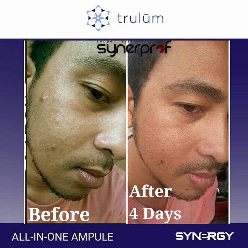 Krim Jerawat & Pemutih Wajah Cepat Ampuh Trulum Skincare Anti Aging