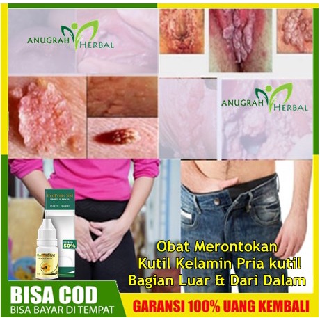 Obat Merontokan Kutil Kelamin Pria kutil Bagian Luar - 0bat Perontok Kutil Kelamin - Paket Obat Kuti