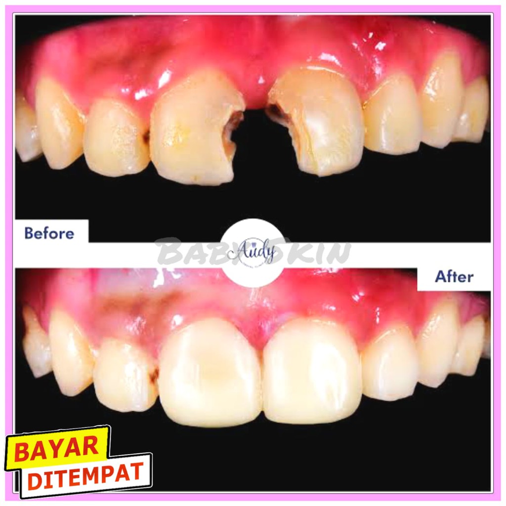 SANGAT KUAT  Gigi Palsu Penutup Ompong 100% ORIGINAL Penambal Gigi Berlubang Permanen Tanpa ke Dokt