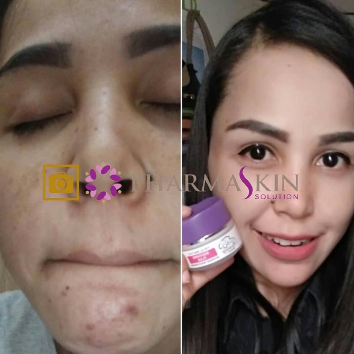 Pharmaskin Paket Full Treatment Acne Glowing Series Bebas Menghilangkan Jerawat Perawatan Wajah Berjerawat Glowing Ampuh Resmi BPOM Halal Original-7