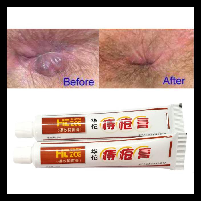 Salep Wasir Ambeyen Ambeien Sakit Bab Ampuh Asli Cina Huatuo Zhichuang Gao