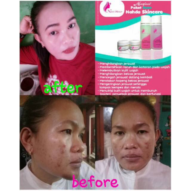 NAHDA SKINCARE ACNE GLOWING 100% ORIGINAL  atasi macam jerawat