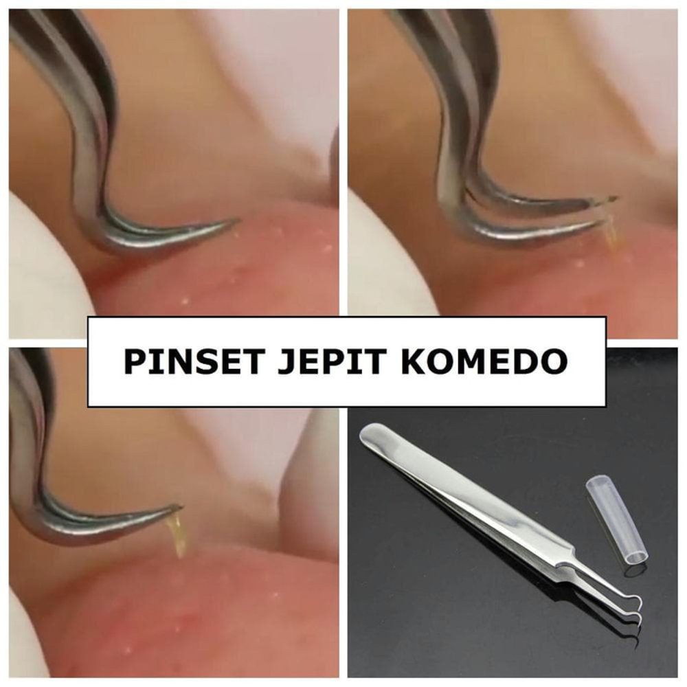 Pinset Komedo / Pinset Jerawat / Jepitan Komedo / Blackhead Tweezer (STAINLESS STEEL)