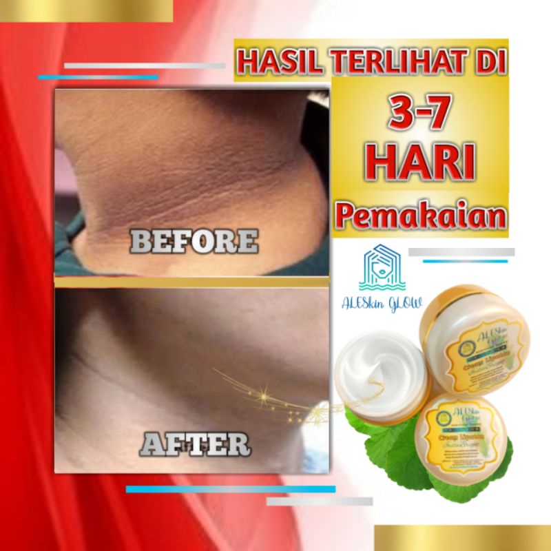 MALAYEKA CREAM PEMUTIH KETIAK Bokong Leher dan Selangkangan-Cream Pencerah Lipatan-Cream Underarm