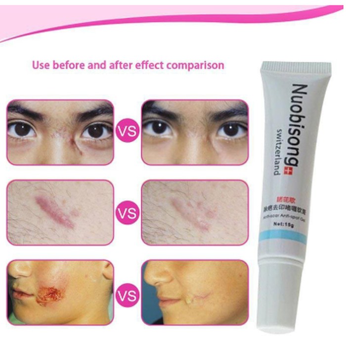Murah Obat Penghilang Bekas Luka Jerawat Selulit Scar Gel Gatal Nuobisong Berkualitas