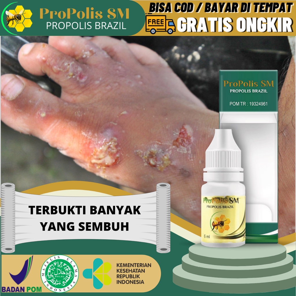 Jual Obat Oles Budug Borok Tetes Gatal Bernanah Herpes Obat Budug