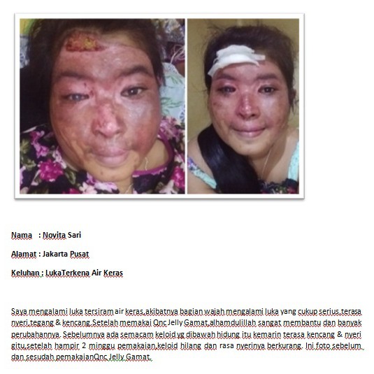 Obat Luka Tersiram Air Panas Luka Tersiram Air Panas Obat Oles Luka Tersiram Air Panas Obat Luka Shopee Indonesia