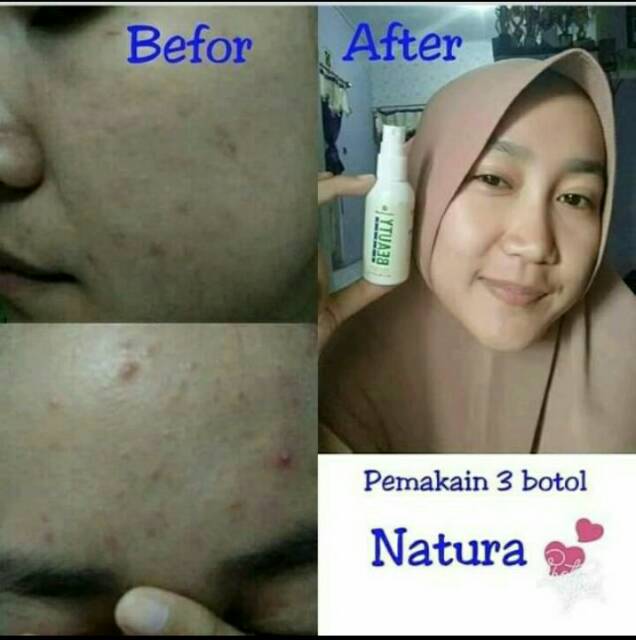 Natura Beauty Spray Solusi Jerawat Gatal Bopeng Cacar Memutihkan Bekas Luka Shopee Indonesia Cara memutihkan wajah dengan kopi hitam dan madu ini bisa anda lakukan dengan mencampur 3 sendok makan kopi hitam dan madu. natura beauty spray solusi jerawat gatal bopeng cacar memutihkan bekas luka