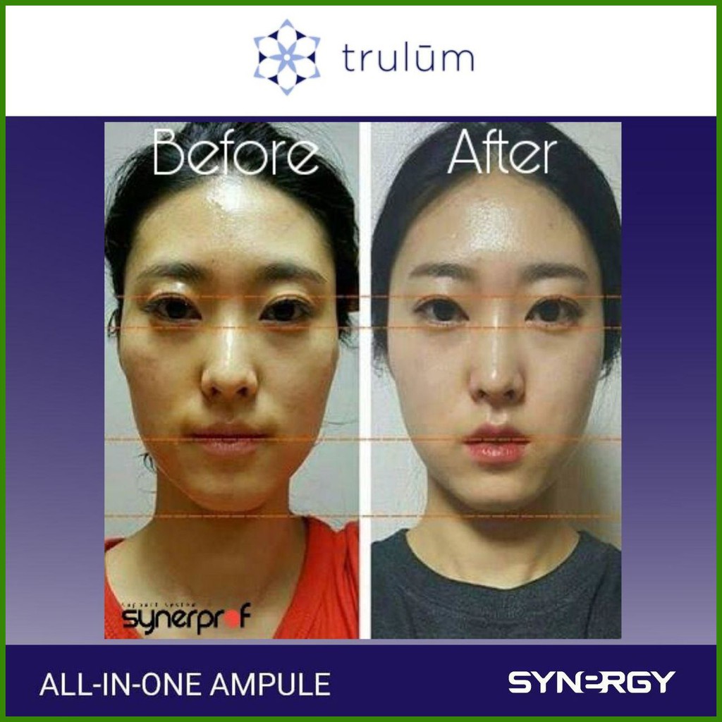 µ975­ Krim Untuk Muka Berminyak, Cream Untuk Menghilangkan Bopeng Di Wajah Bekas Cacar Trulum