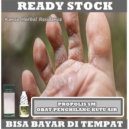 Obat Kutu Air Ruam Dan Gatal - Obat Gatal Jamur Air Di Kaki - Obat Kutu Air Pada Kaki - Obat Kutu Air Di Tangan - Obat Infeksi Jamur Di Kaki - Obat Penghilang Kutu Air - Obat Gatal Berair Di Jari Kaki &amp; Tangan - Obat Gatal Kulit Mengelupas