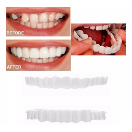 GIGI PALSU ATAS BAWAH GIGI PALSU LEPAS PASANG VENEER snap on smile