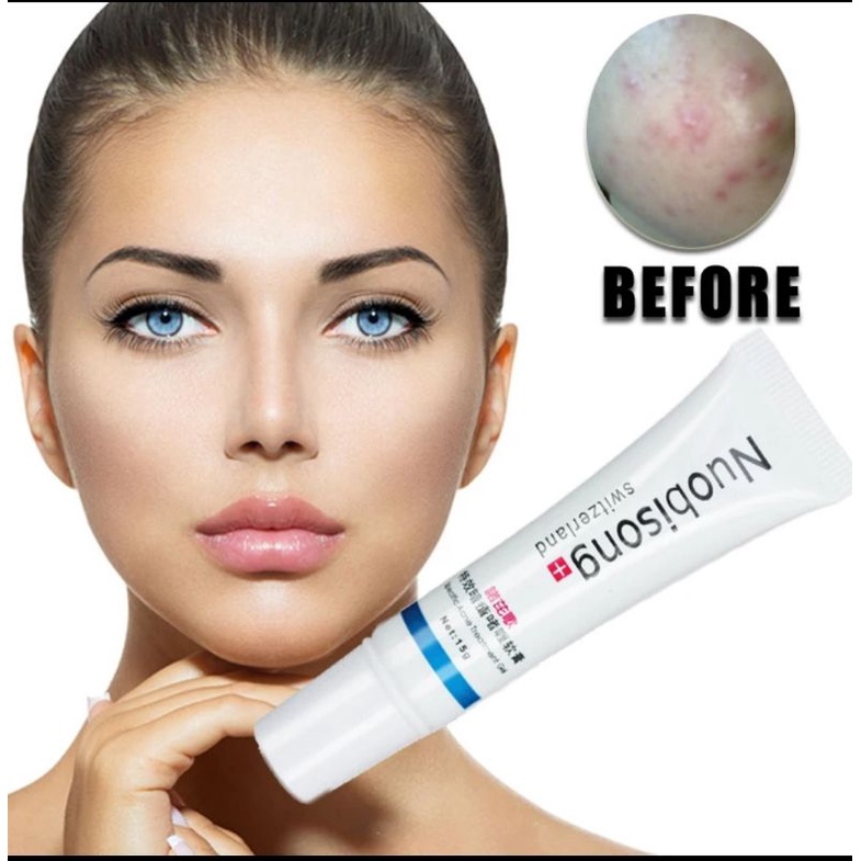 ORIGINAL GEL NUOBISONG HILANGKAN JERAWAT DAN BEKAS JERAWAT