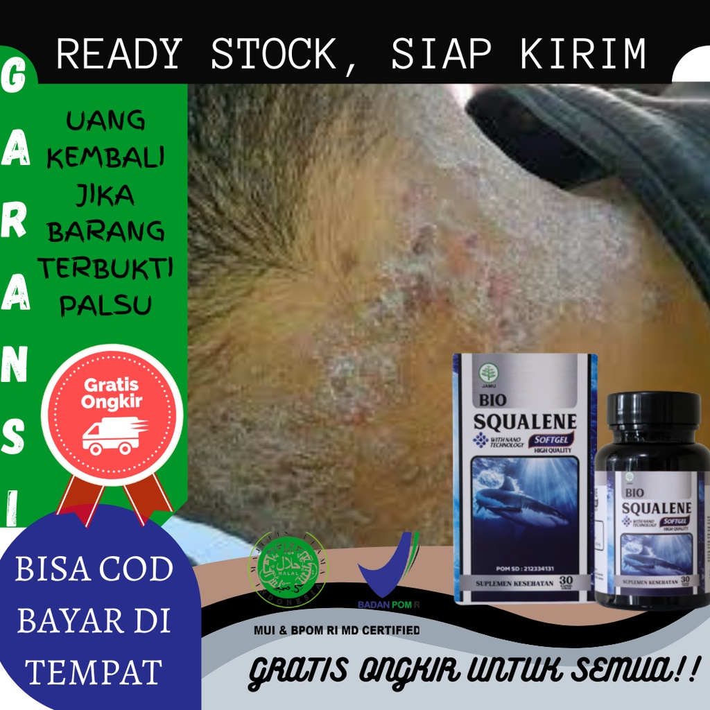 Obat Gatal Pada Kulit, Gatal Alergi Bentol Kulit , Alergi Dingin, Alergi Debu, Gatal Kurap, Gatal Ex