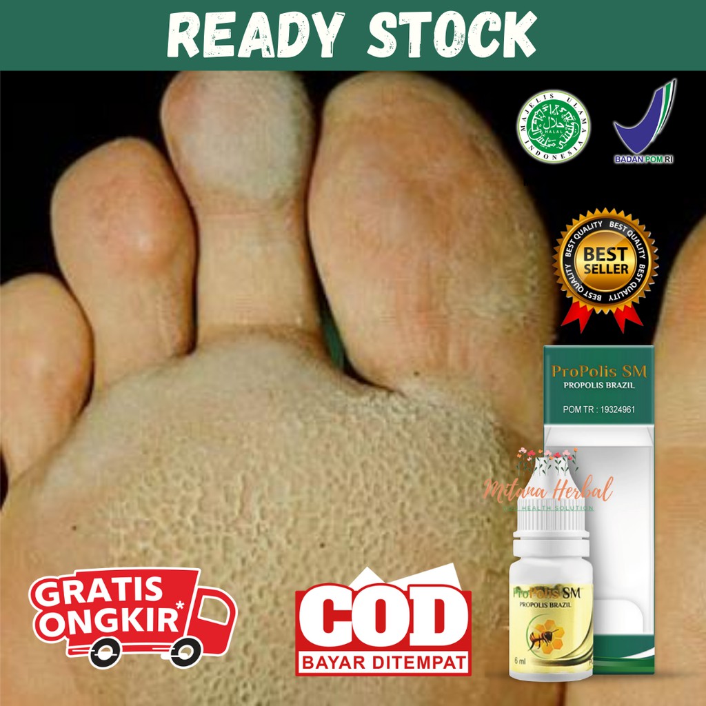 MIAL Obat Kaki Rayapan Dan Bau, Obat Kaki Rayapan , Obat Kaki Rayapan Berlubang, Obat Kaki Kapalan, 