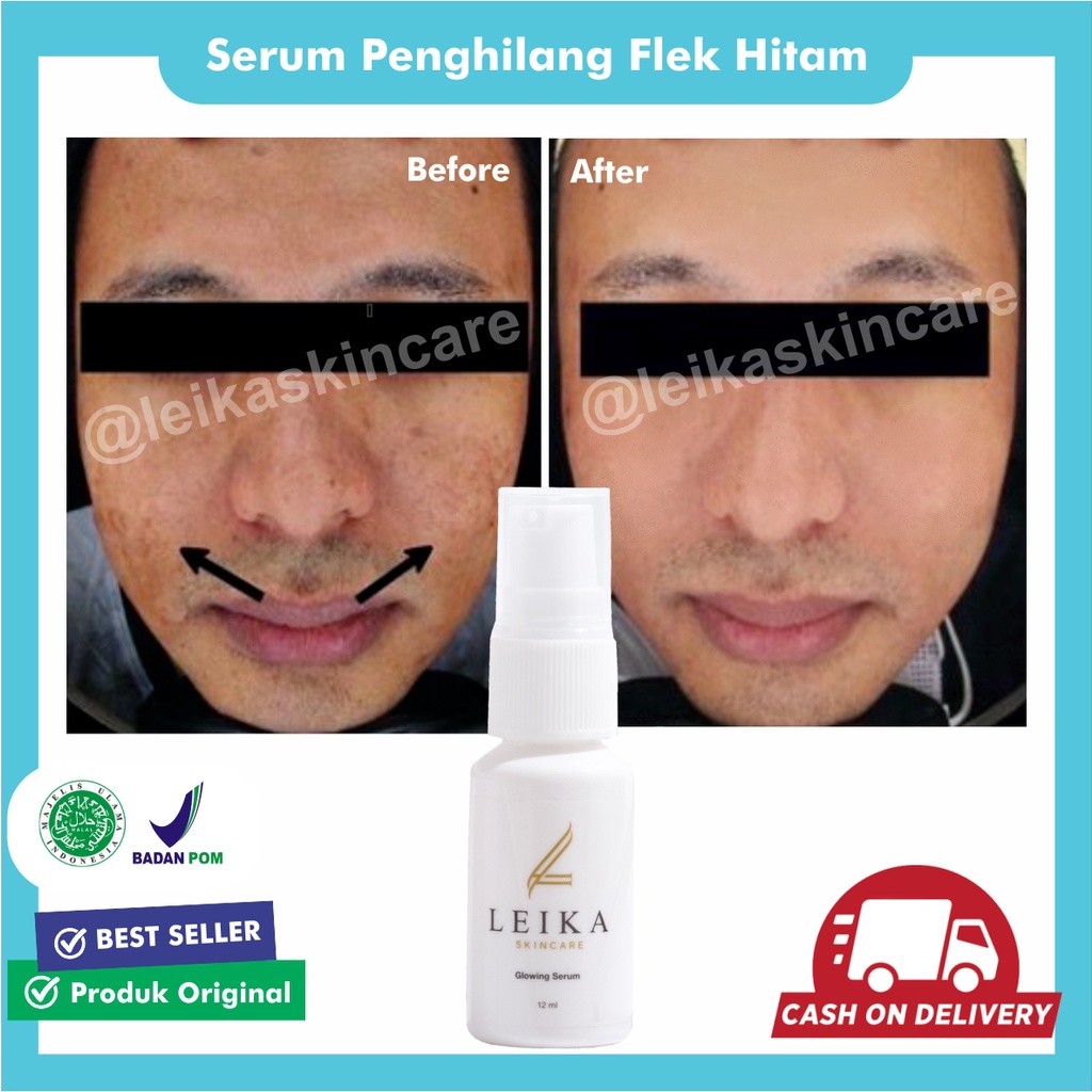 Penghilang Flek Hitam Di Wajah AMPUH Serum Wajah Menghilangkan Flek Hitam Serum Flek Hitam Membandel